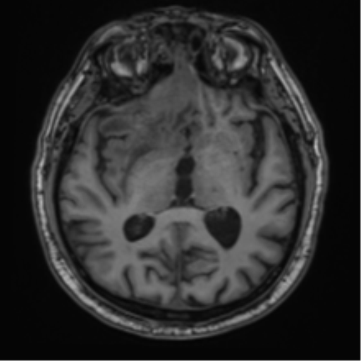 File:Atypical meningioma (WHO grade II) with brain invasion (Radiopaedia 57767-64729 Axial T1 24).png