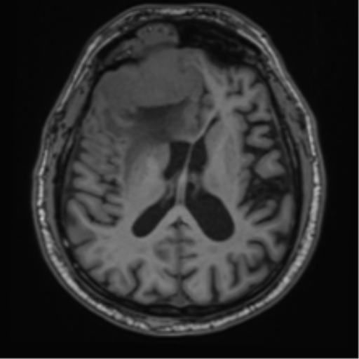 File:Atypical meningioma (WHO grade II) with brain invasion (Radiopaedia 57767-64729 Axial T1 28).png