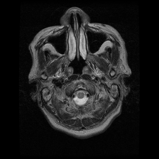 File:Atypical meningioma (WHO grade II) with osseous invasion (Radiopaedia 53654-59716 Axial T2 1).png
