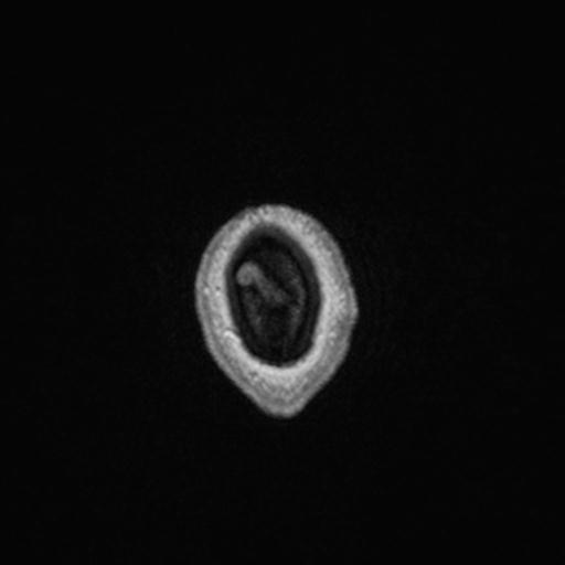 Atypical meningioma (grade II) - en plaque (Radiopaedia 29633-30147 Axial T1 C+ 174).jpg