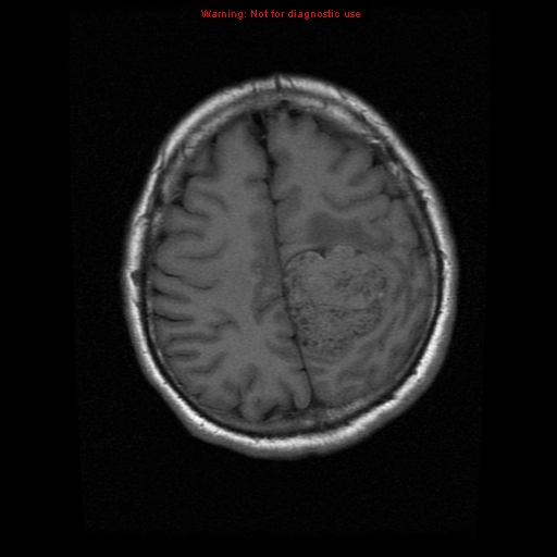 File:Atypical meningioma - grade II (Radiopaedia 13303-13305 Axial T1 17).jpg