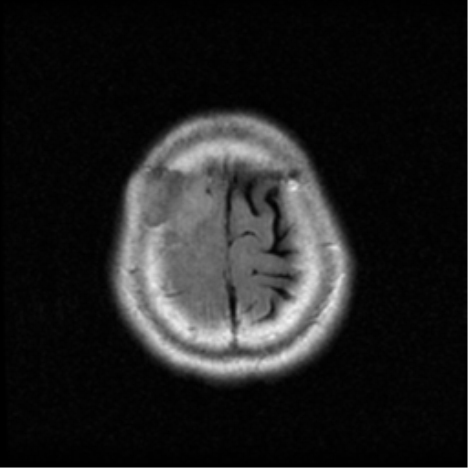 File:Atypical meningioma with skull invasion (Radiopaedia 34357-35648 Axial FLAIR 20).png