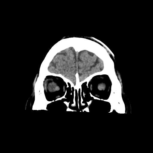 Atypical meningioma with skull invasion (Radiopaedia 34357-35649 Coronal non-contrast 13).png