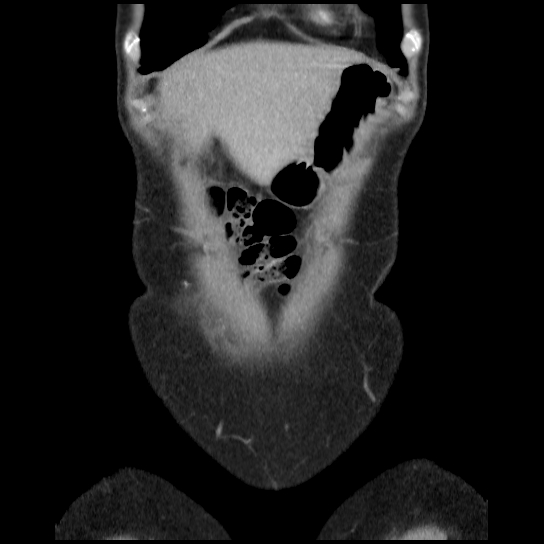 File:Atypical renal cyst (Radiopaedia 17536-17251 C 34).jpg