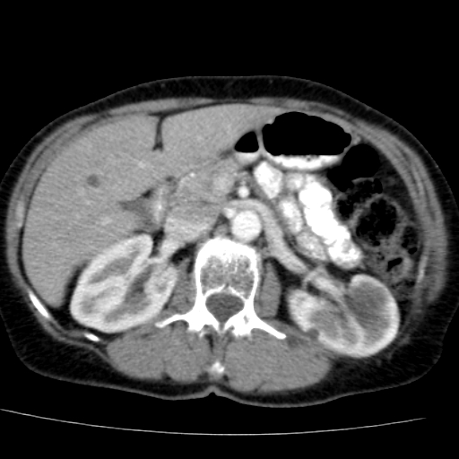 File:Atypical renal cyst (Radiopaedia 17536-17251 renal cortical phase 14).jpg