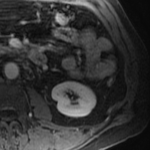 File:Atypical renal cyst on MRI (Radiopaedia 17349-17046 D 23).jpg