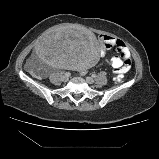 File:Atypical retroperitoneal lymphocoeles with large leiomyoma of uterus (Radiopaedia 32084-33024 A 26).jpg