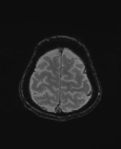Autoimmune limbic encephalitis (Radiopaedia 30363-31005 SWI - magnitude 70).jpg