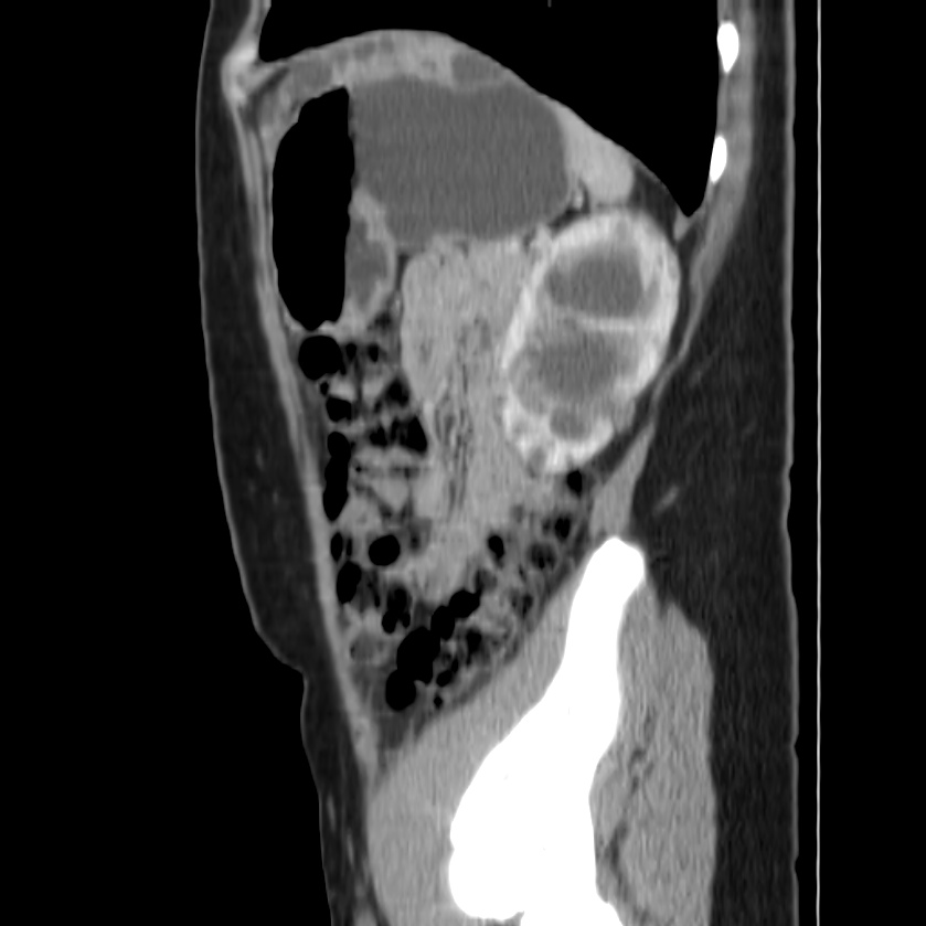 Autosomal dominant polycystic kidney disease (Radiopaedia 23061-23093 F 43).jpg