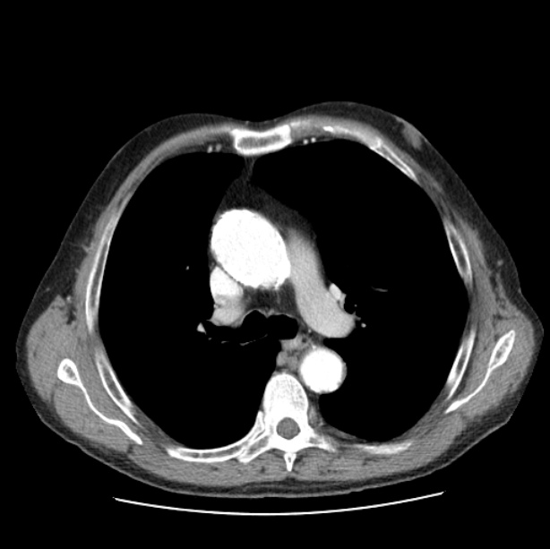 Autosomal dominant polycystic kidney disease (Radiopaedia 27851-28094 B 24).jpg