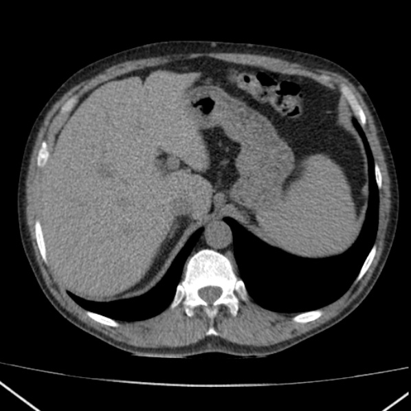 File:Autosomal dominant polycystic kidney disease (Radiopaedia 36539-38101 Axial non-contrast 18).jpg