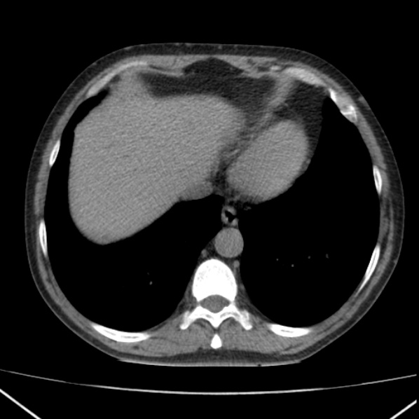 File:Autosomal dominant polycystic kidney disease (Radiopaedia 36539-38101 Axial non-contrast 8).jpg