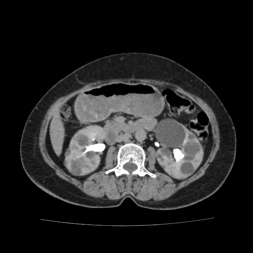 Autosomal dominant polycystic kidney disease (Radiopaedia 38189-40194 Axial C+ delayed 22).jpg