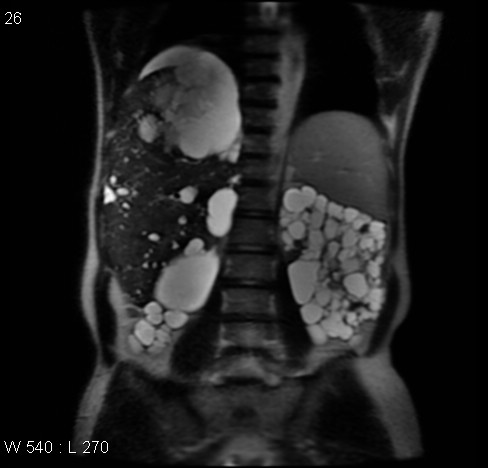 File:Autosomal dominant polycystic kidney disease (Radiopaedia 5202-6969 Coronal T2 10).jpg