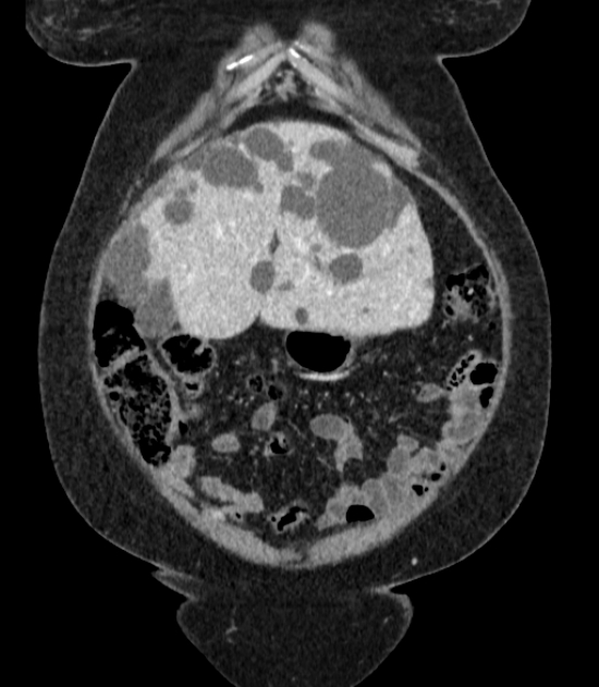 Autosomal dominant polycystic kidney disease (Radiopaedia 57124-64017 B 14).jpg