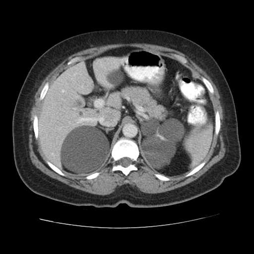 Autosomal dominant polycystic kidney disease with hepatic involvement (Radiopaedia 32693-33662 B 21).jpg