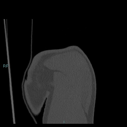 Avascular necrosis after fracture dislocations of the proximal humerus (Radiopaedia 88078-104655 Coronal bone window 33).jpg