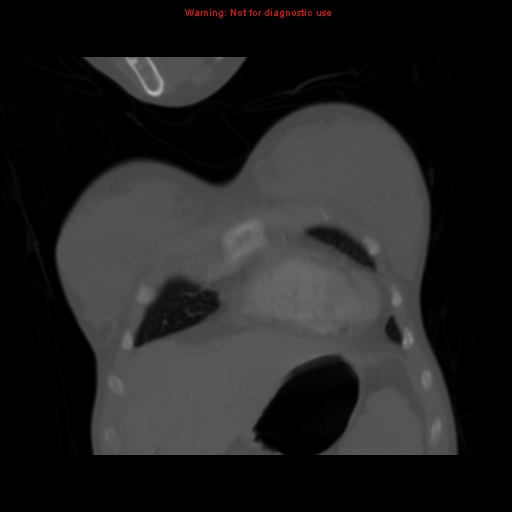 Avascular necrosis in sickle cell disease (Radiopaedia 17448-17152 Coronal bone window 18).jpg