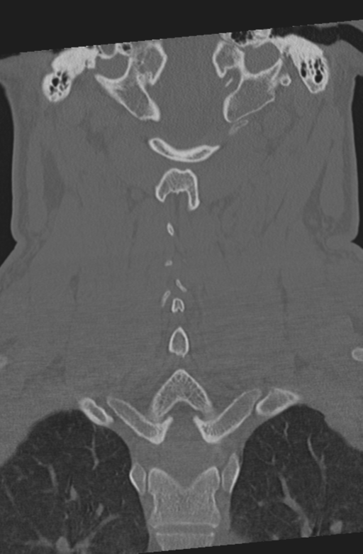Axis peg fracture (type 3) and atlas lateral mass (type 4) fracture (Radiopaedia 37474-39324 Coronal bone window 36).png