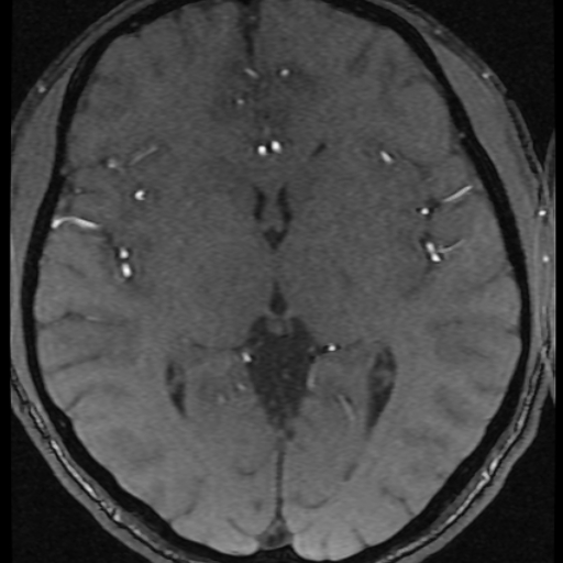 Azygos anterior cerebral artery (Radiopaedia 17059-16756 Axial MRA 16).jpg
