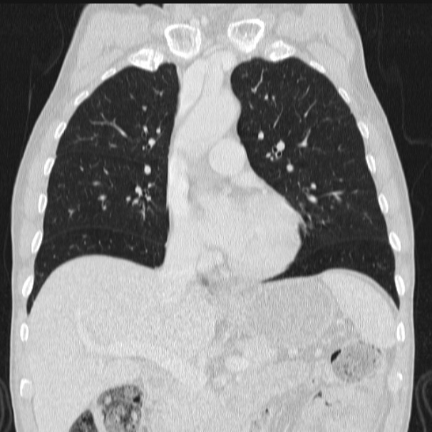 Azygos lobe (Radiopaedia 38259-40275 Coronal lung window 34).jpg