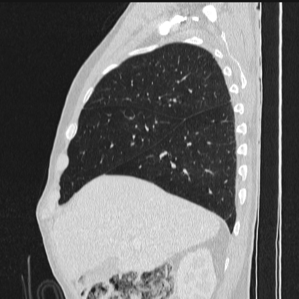 Azygos lobe (Radiopaedia 38259-40275 lung window 26).jpg