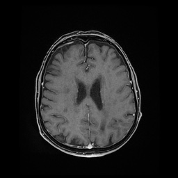 Balo concentric sclerosis (Radiopaedia 53875-59982 Axial LAVA C+ 172).jpg