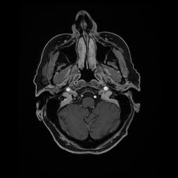 Balo concentric sclerosis (Radiopaedia 53875-59982 Axial LAVA C+ 45).jpg