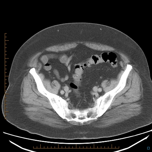 File:Bariatric balloon causing gastric outlet obstruction (Radiopaedia 54449-60672 A 34).jpg