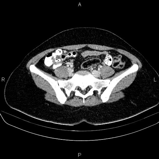 File:Bartholin gland cyst (Radiopaedia 62635-70930 Axial Post contrast 18).jpg