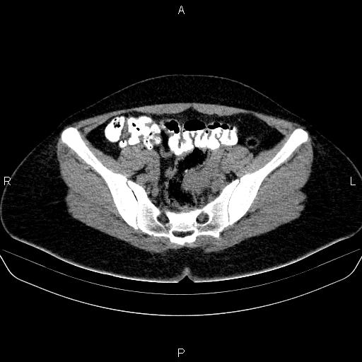 Bartholin gland cyst (Radiopaedia 62635-70930 Axial non-contrast 32).jpg