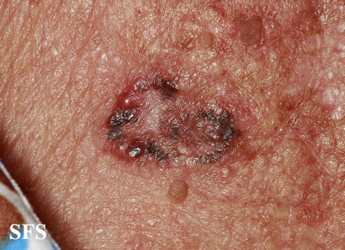 Basal Cell Carcinoma (Dermatology Atlas 258).jpg