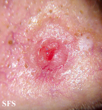 Basal Cell Carcinoma (Dermatology Atlas 89).jpg
