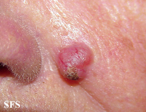 Basal Cell Carcinoma (Dermatology Atlas 95).jpg