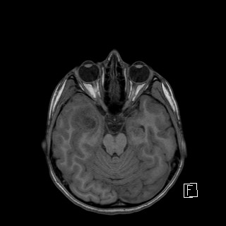 Base of skull rhabdomyosarcoma (Radiopaedia 32196-33142 Axial T1 18).jpg
