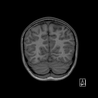 Base of skull rhabdomyosarcoma (Radiopaedia 32196-33142 Coronal T1 41).jpg