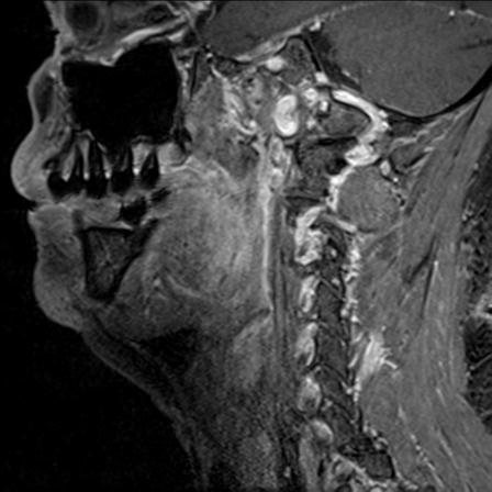 Base of tongue squamous cell carcinoma (Radiopaedia 31174-31884 F 116).jpg