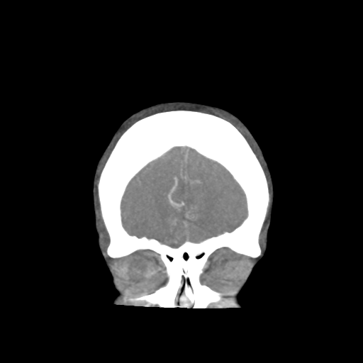 Basilar and bilateral vertebral artery occlusion (Radiopaedia 45592-49723 B 16).png
