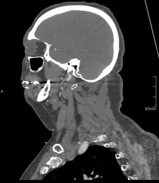 File:Basilar artery aneurysm (Radiopaedia 56261-62932 C 5).jpg