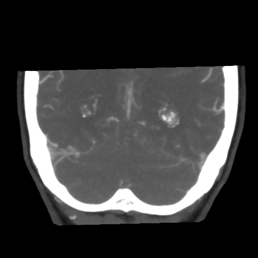 File:Basilar artery fenestration and aneurysms with subarachnoid hemorrhage (Radiopaedia 40066-42573 B 44).png