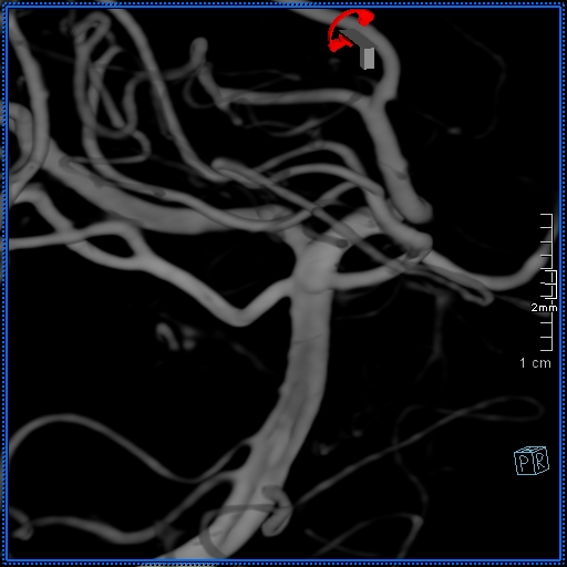 Basilar artery perforator aneurysm (Radiopaedia 82455-99524 3D Left VA 78).jpg