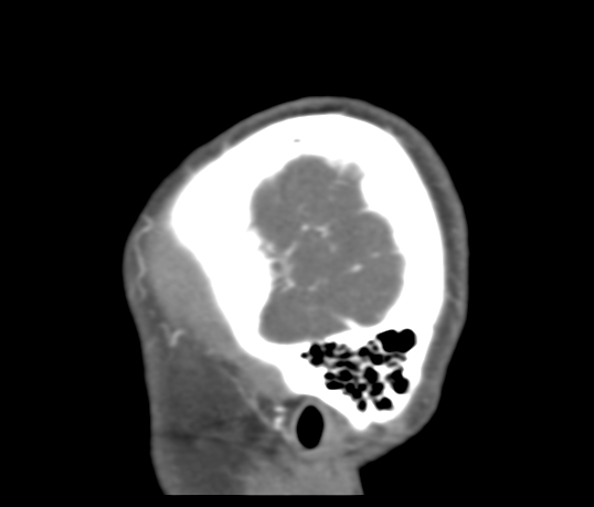 Basilar tip aneurysm with coiling (Radiopaedia 53912-60086 C 129).jpg