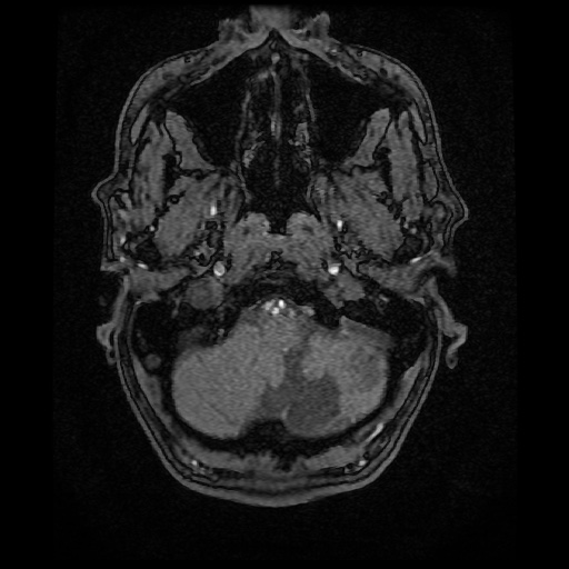 Basilar top and left middle cerebral artery aneurysm (Radiopaedia 61965-70031 Axial MRA 5).jpg