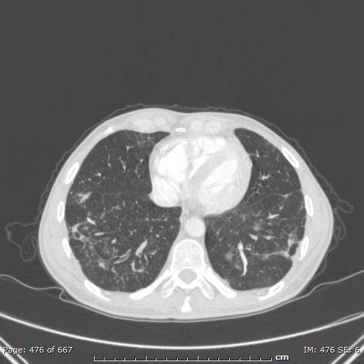 File:Behçet disease (Radiopaedia 44247-47889 Axial lung window 65).jpg