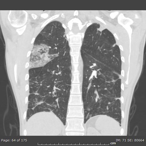 Behçet disease (Radiopaedia 44247-47889 Coronal lung window 17).jpg