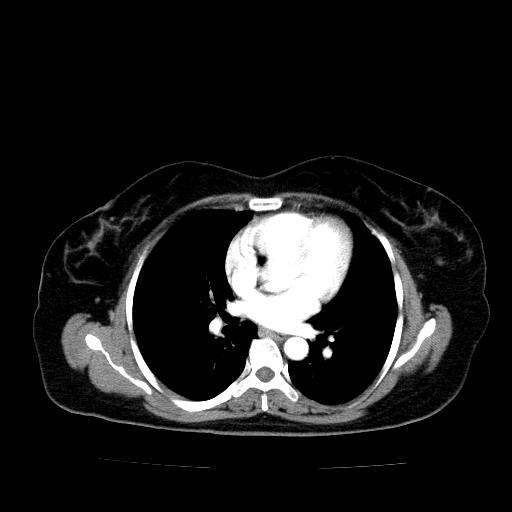 File:Benign spindle cell tumor - abdominopelvic (Radiopaedia 61300-69212 A 1).jpg