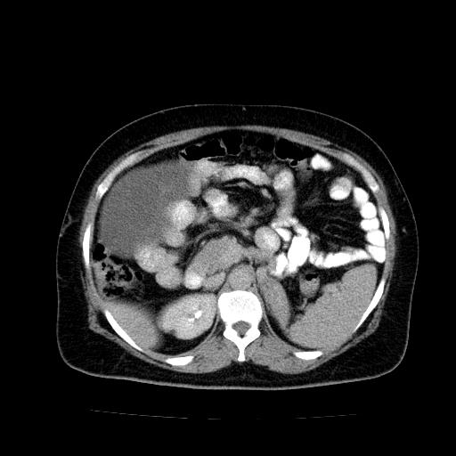 Benign spindle cell tumor - abdominopelvic (Radiopaedia 61300-69212 Axial C+ delayed 19).jpg