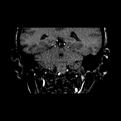 File:Berry aneurysm of the terminal internal carotid artery (Radiopaedia 88286-104918 Coronal TOF 74).jpg