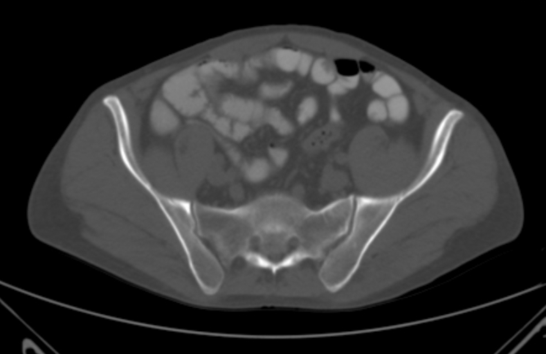 File:Bertolotti syndrome (Radiopaedia 58974-66235 Axial bone window 4).jpg
