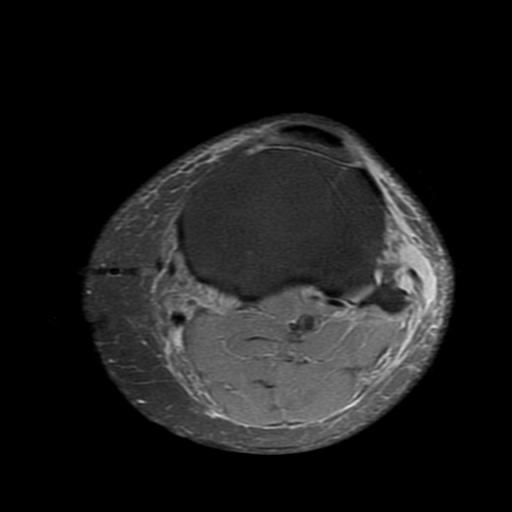 File:Biceps femoris distal tendon avulsion (Radiopaedia 15109-14987 Axial PD fat sat 21).jpg